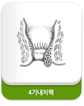4기내치핵