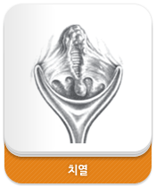치열